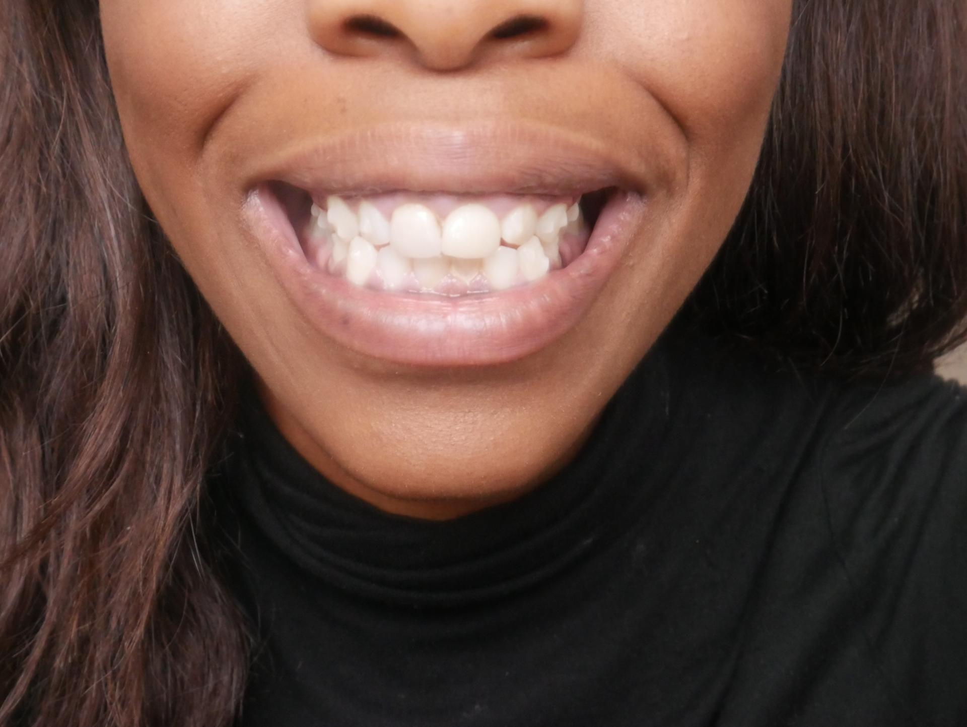 My Invisalign Progress and Invisalign Review| I got Invisalign clear braces| Find out more about the first few weeks Kitty and B